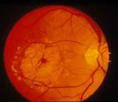 Dominant Stargardt Disease